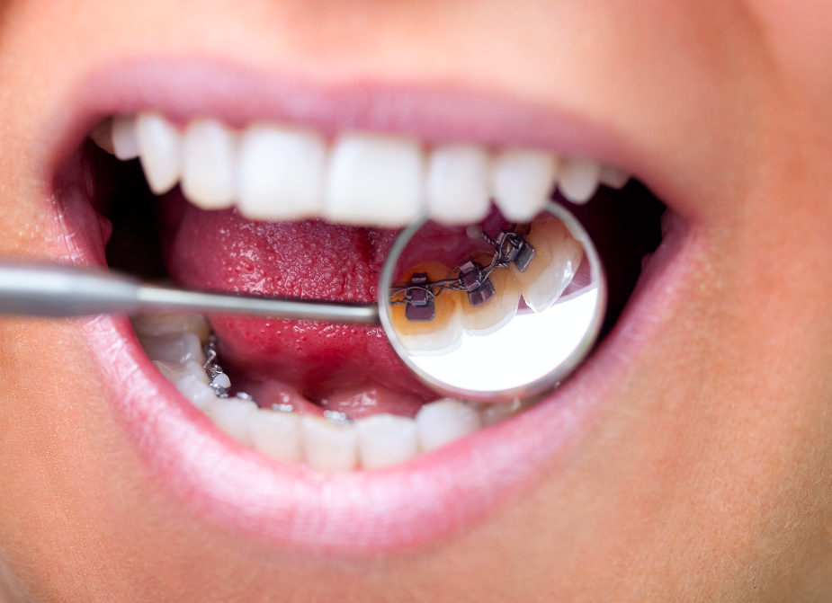 WIN lingual braces WIN lingual braces