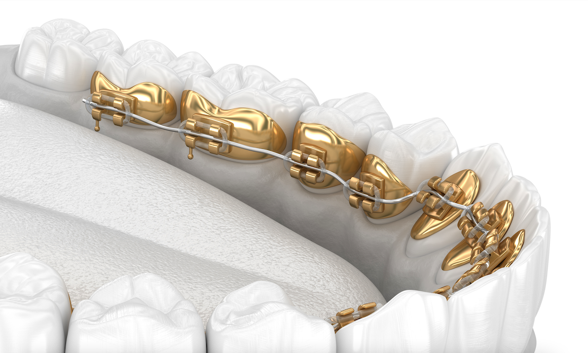 Incognito hidden braces Incognito hidden braces